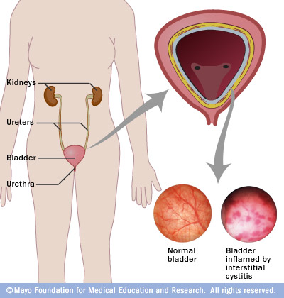 This interstitial cystitis and relief during orgasm pussy